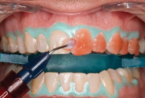 Izbeljivanje zuba