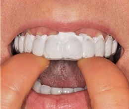 Fluorizacija zuba