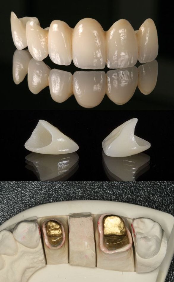 Bezmetalne krunice i mostovi Bezmetalne krunice i mostovi